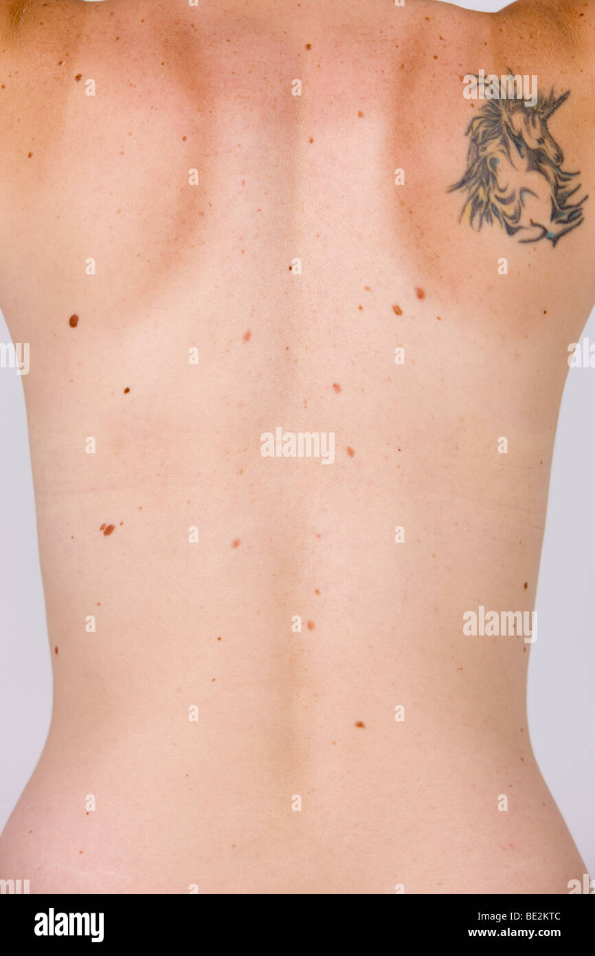 Los lunares en la espalda, el riesgo de cáncer de piel Foto de stock