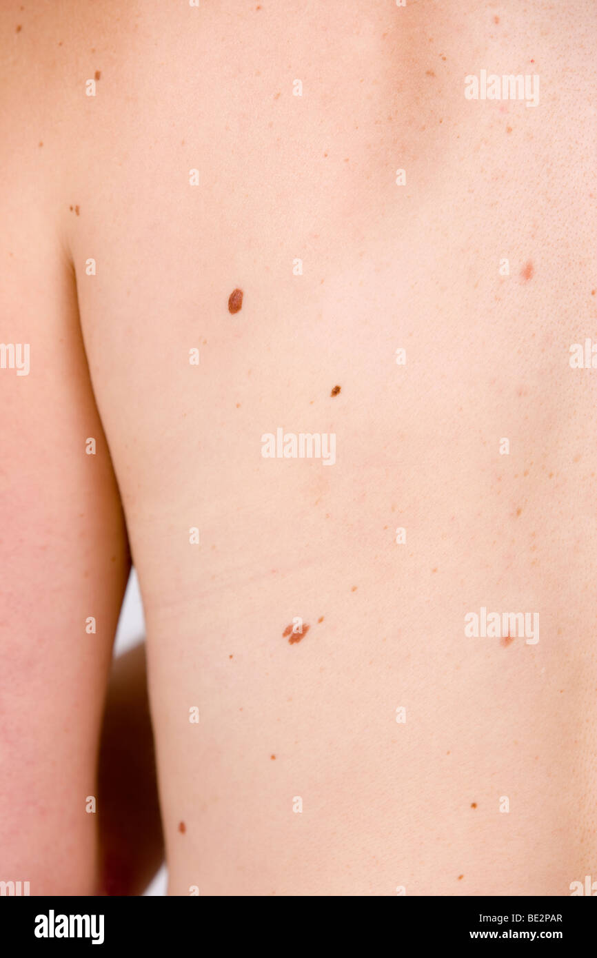 Los lunares en la espalda, el riesgo de cáncer de piel Foto de stock