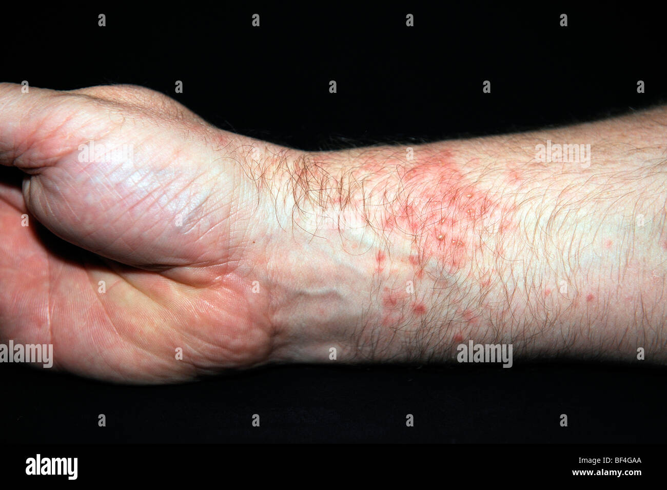 Muy rojo, ampollas en la piel, ronchas o urticaria después del contacto con  las anémonas de mar (Heteractis spec Fotografía de stock - Alamy