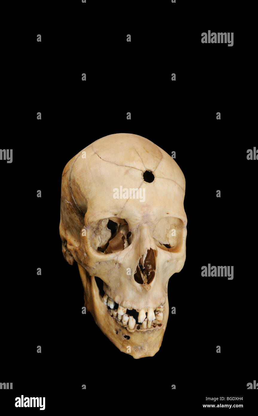 Orificio de bala con fracturas en el cráneo humano radiante Foto de stock