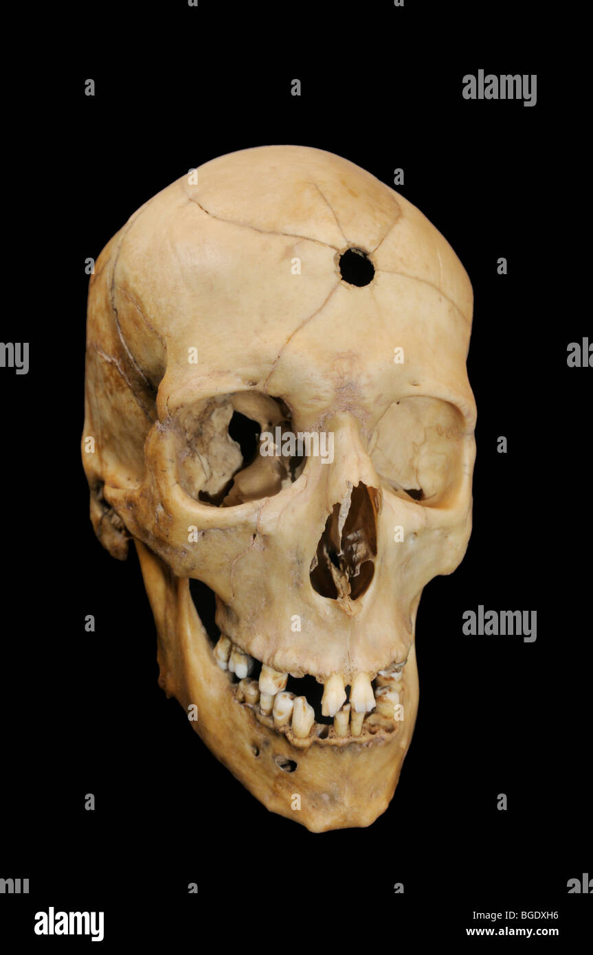 Orificio de bala con fracturas en el cráneo humano radiante Foto de stock