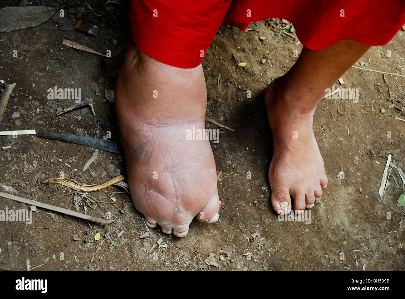 La elefantiasis enfermedad Fotografía de stock Alamy