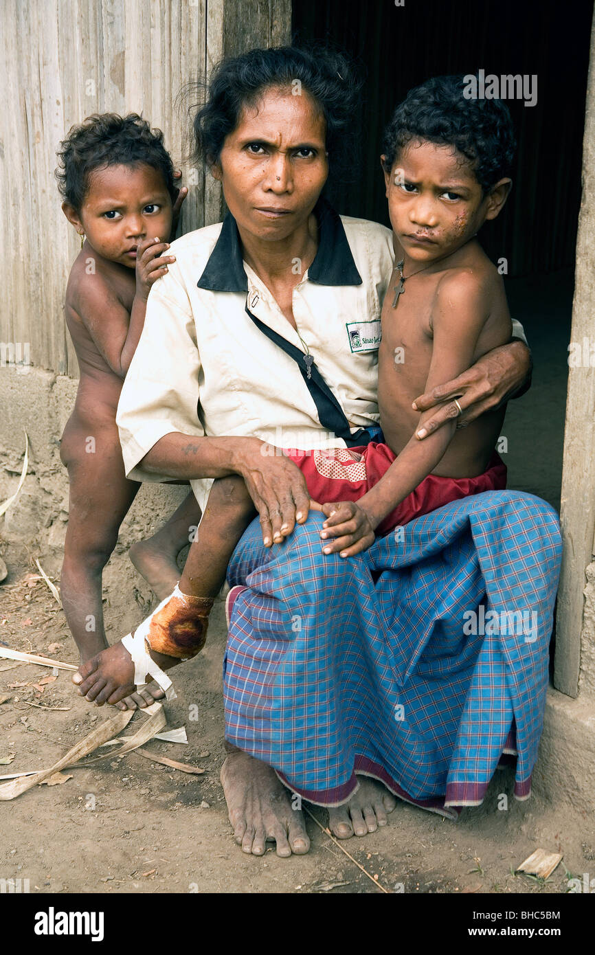 La madre y su hijo lesionado llamamiento de ayuda en las zonas rurales de Timor Oriental con ninguna esperanza de ayuda médica en zonas rurales apartadas, aldea. Foto de stock