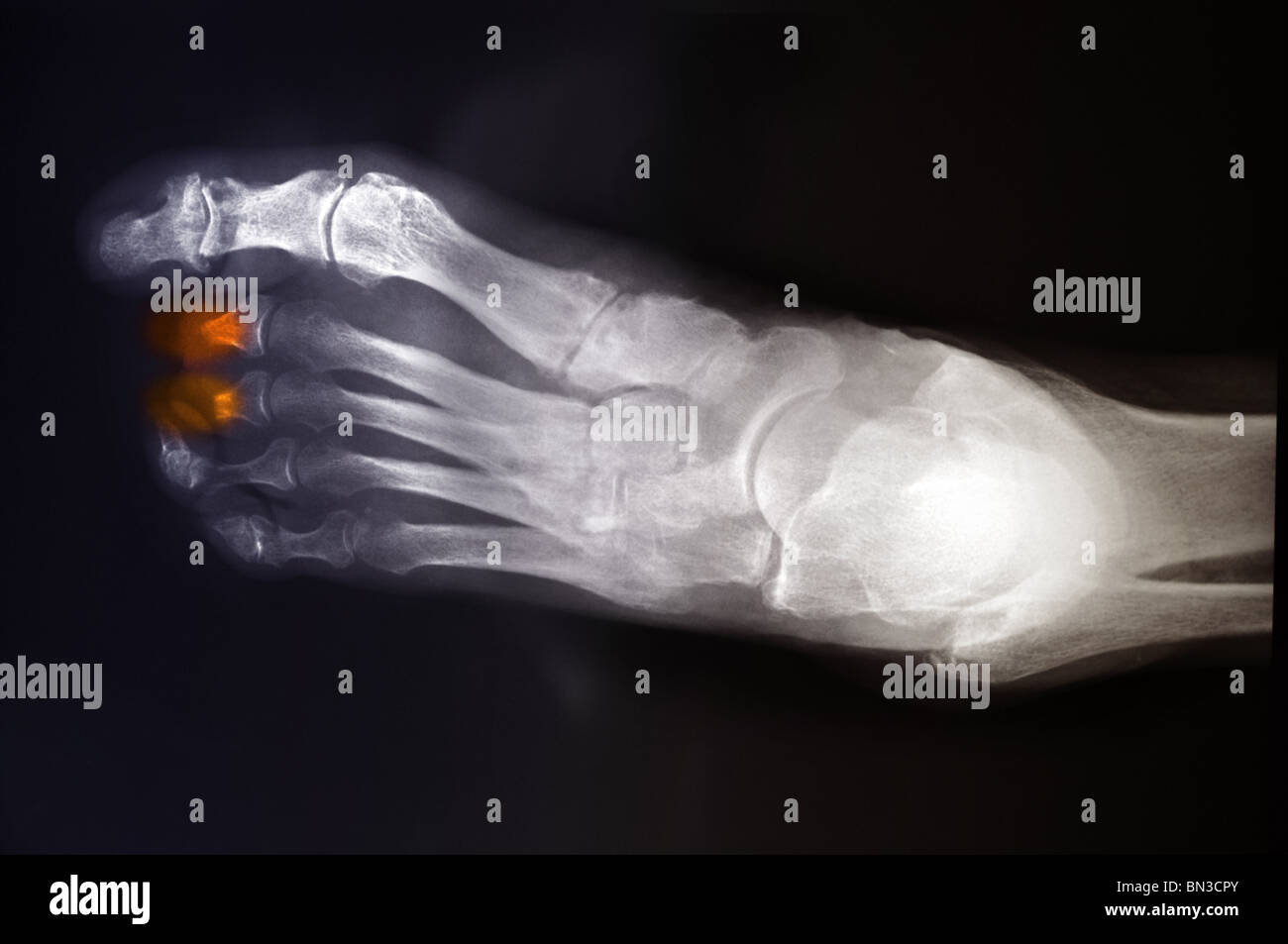 Colorea radiografía de una mujer de 68 años con diabetes que tenía 2 dedos parcialmente amputado Foto de stock