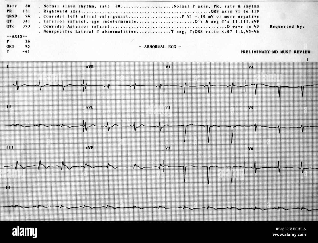 Ritmo sinusal normal fotografías e imágenes de alta resolución Alamy