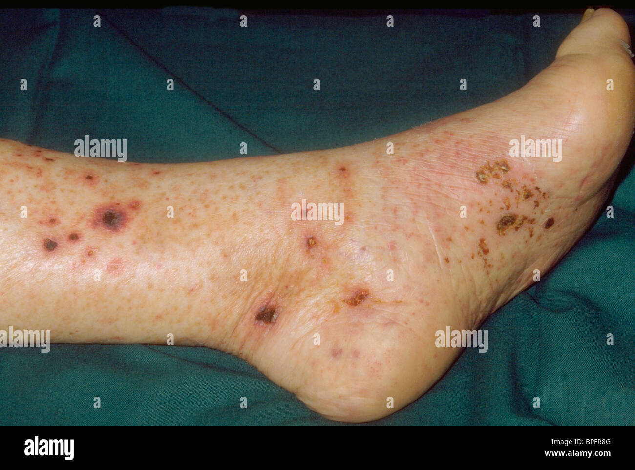 Vasculitis of legs fotografías e imágenes de alta resolución - Alamy