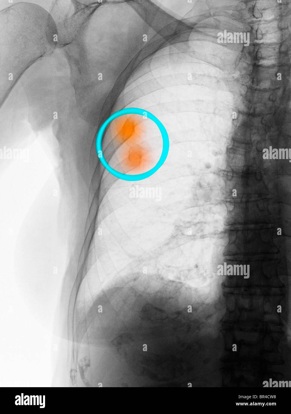 Radiografía de tórax mostrando curado fracturas costales en una mujer de 90 años de edad Foto de stock