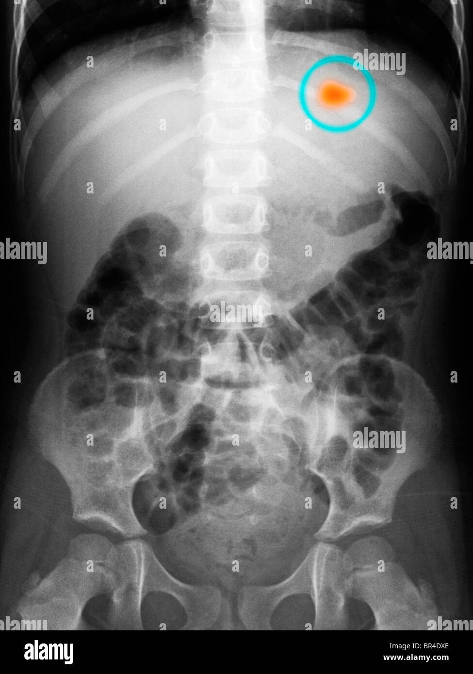 Abdomen radiografía de una niña de 3 años de edad que ingirió un cordón Foto de stock