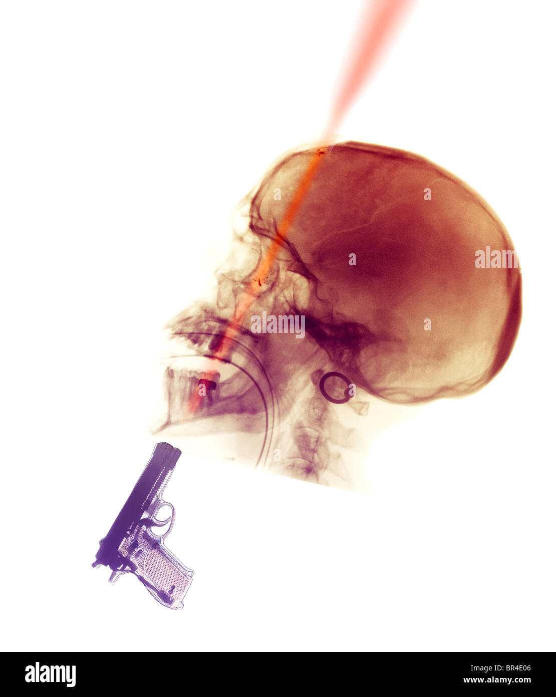 Radiografía del cráneo de un varón de 30 años que se suicidó por el propio disparo en la cabeza. Foto de stock