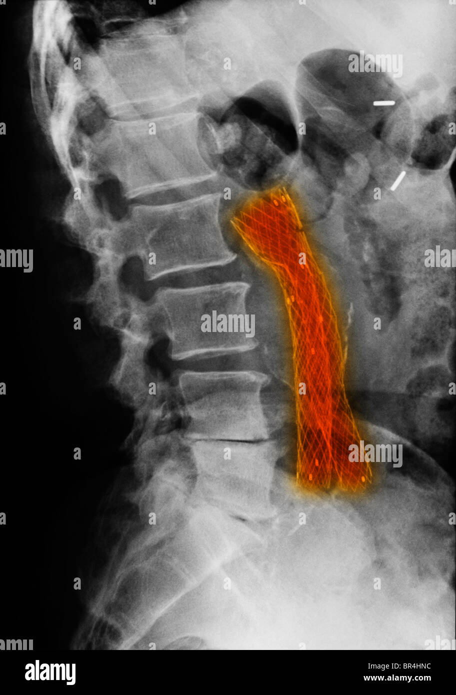 X-ray mostrando un injerto de derivación aortoiliaca malla Foto de stock