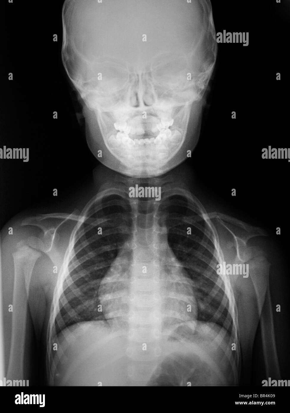 Rayos X de la cabeza y los hombros de un muchacho de 3 años, una radiografía de la cabeza y el pecho de un niño de 3 años Foto de stock