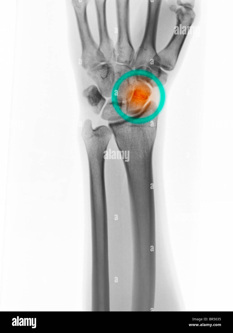 Radiografía de la mano mostrando una fractura del hueso escafoides o naviculares de la muñeca. Foto de stock