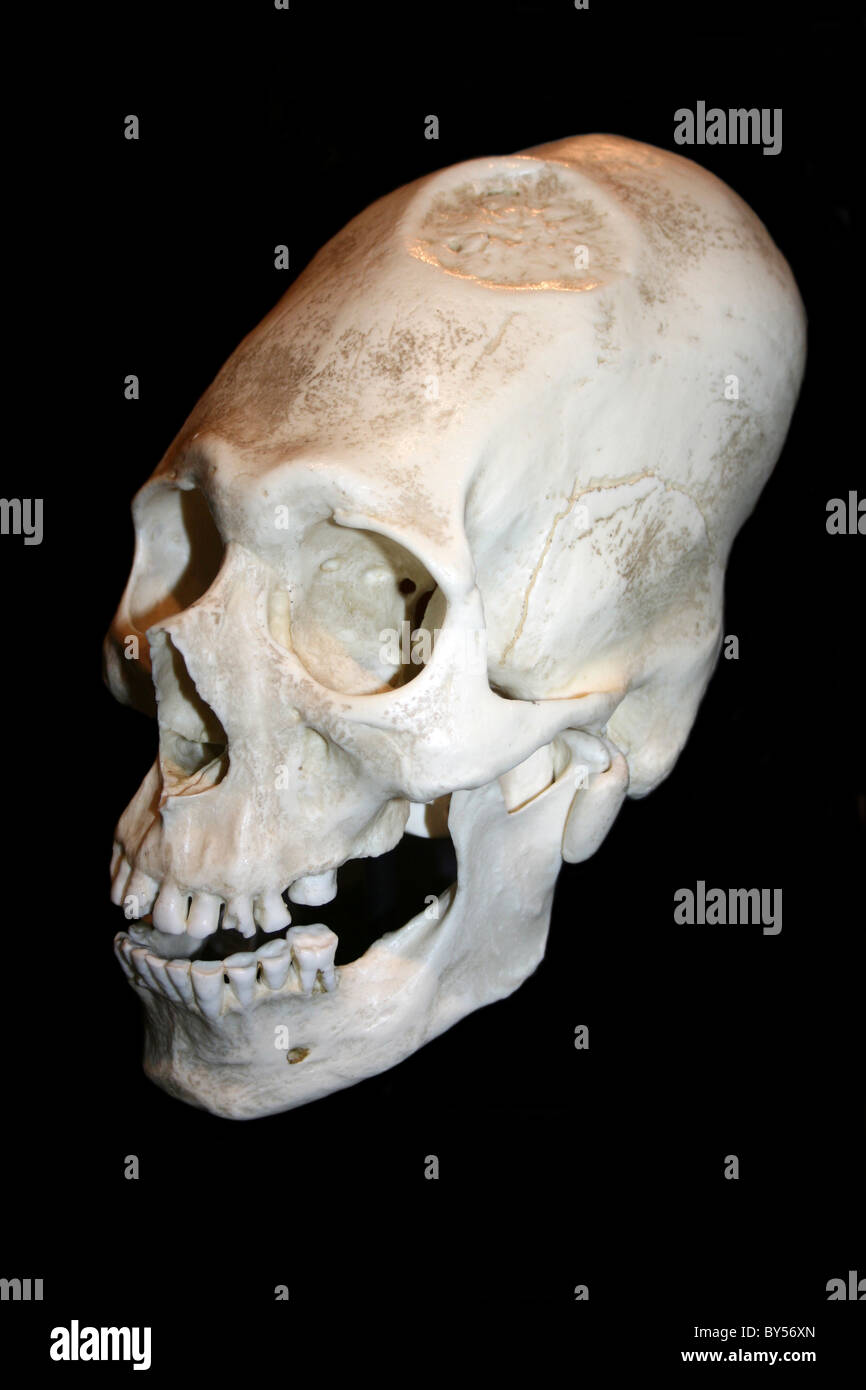 Alargada y Trephinated Male Skull, Perú Foto de stock