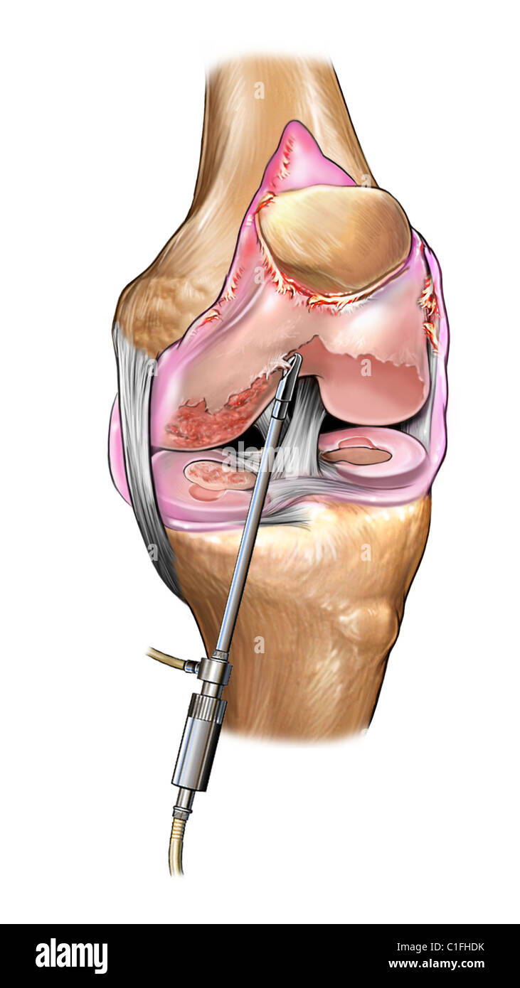 Esta ilustración médica muestra una chrondroplasty a la rodilla. Foto de stock