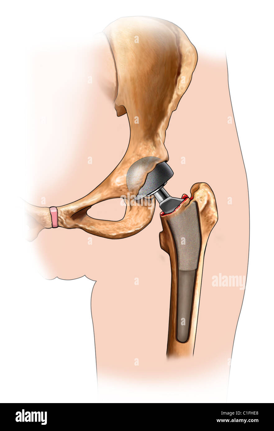 Esta ilustración médica ilustra la prótesis en su lugar durante un procedimiento de reemplazo de cadera. Foto de stock