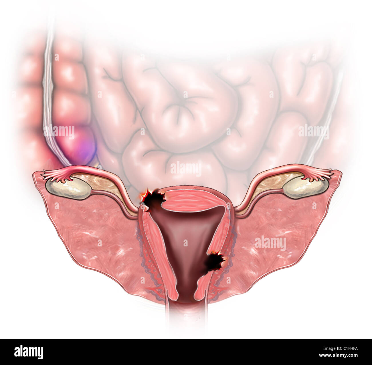 Esta ilustración médica revela un útero perforado. Foto de stock