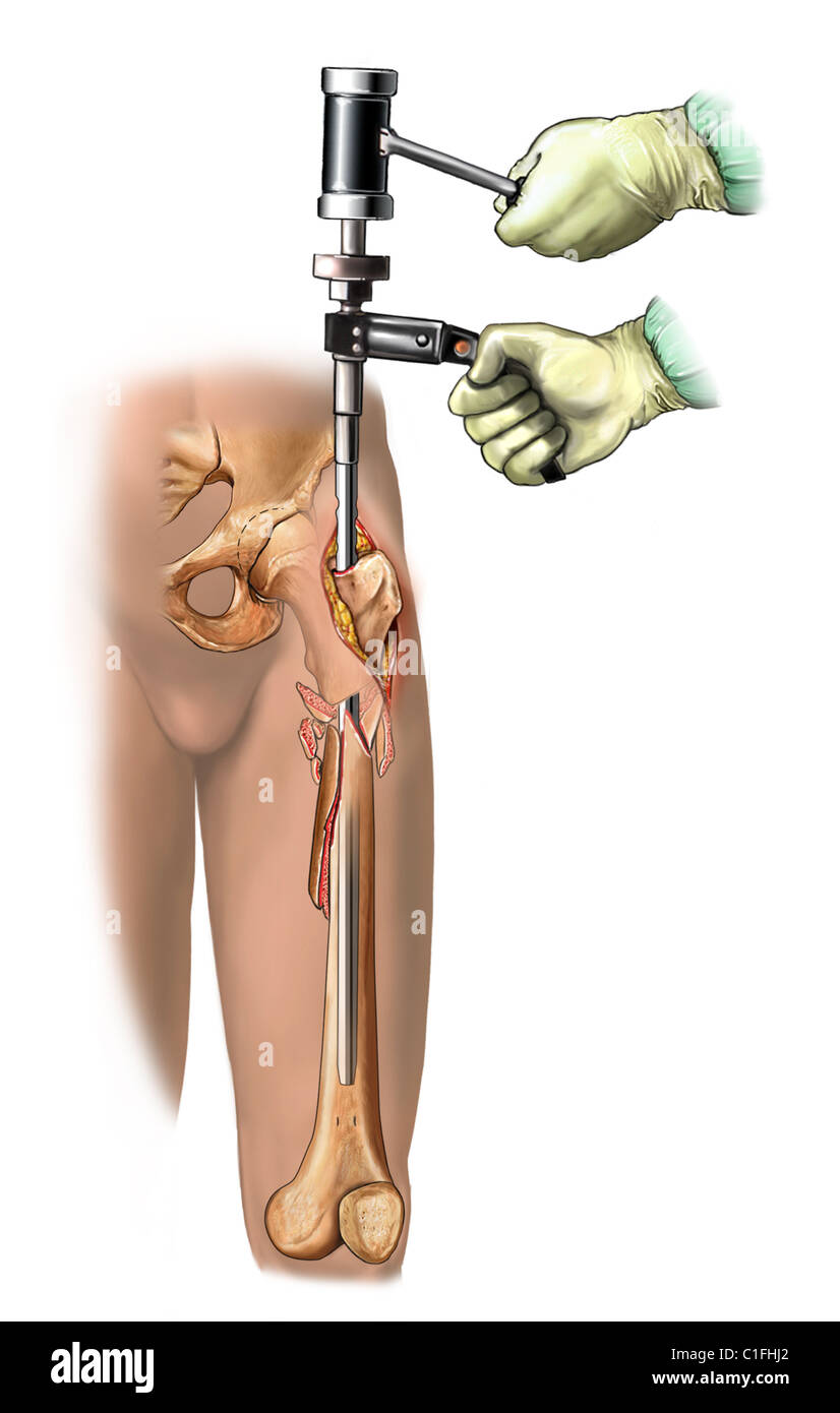 Esta ilustración médica ilustra la fijación tibial. Foto de stock
