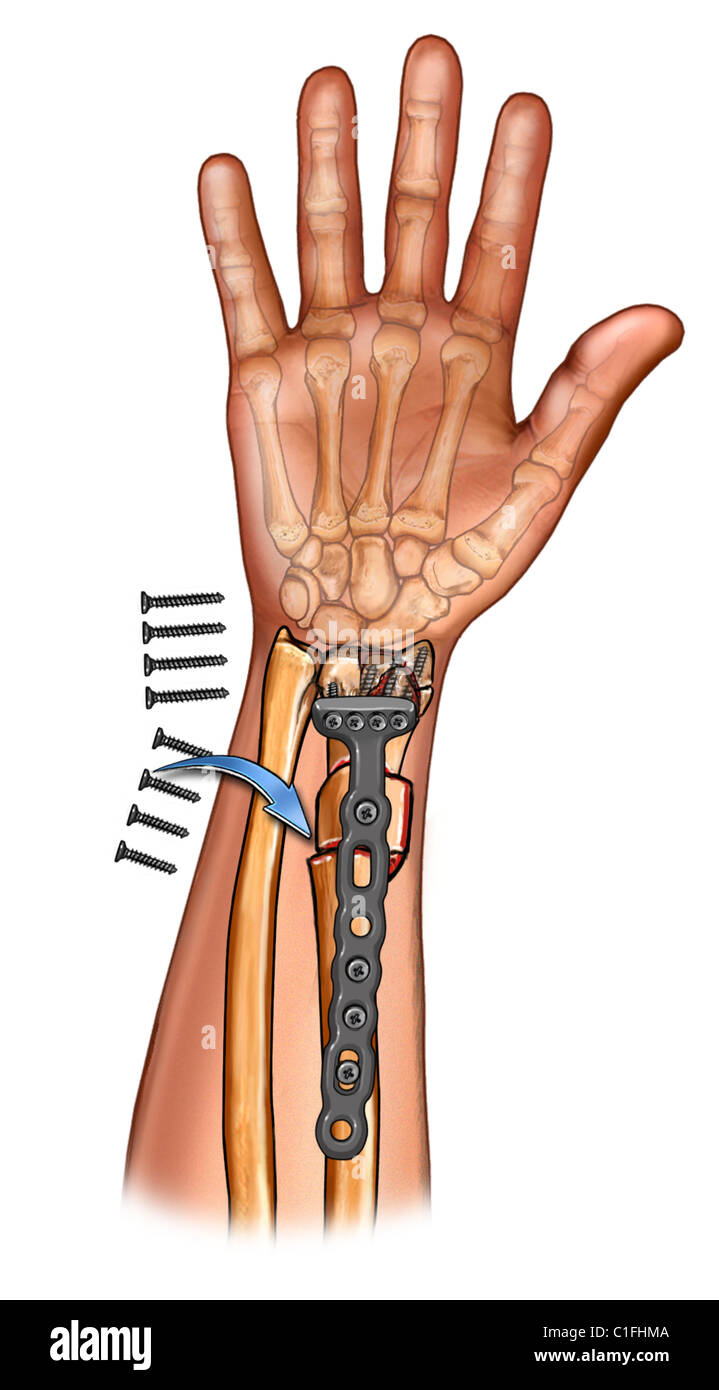 Esta ilustración médica muestra una osteotomía durante una fijación en la  muñeca mediante cirugía Fotografía de stock - Alamy
