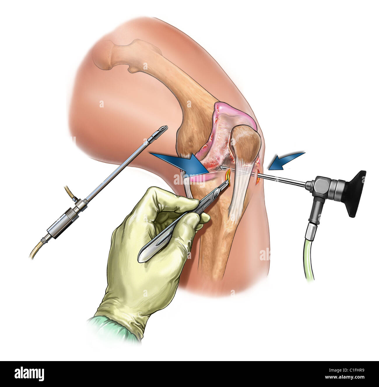 Esta ilustración médica ilustra la inserción de instrumentos artroscópica de rodilla. Foto de stock