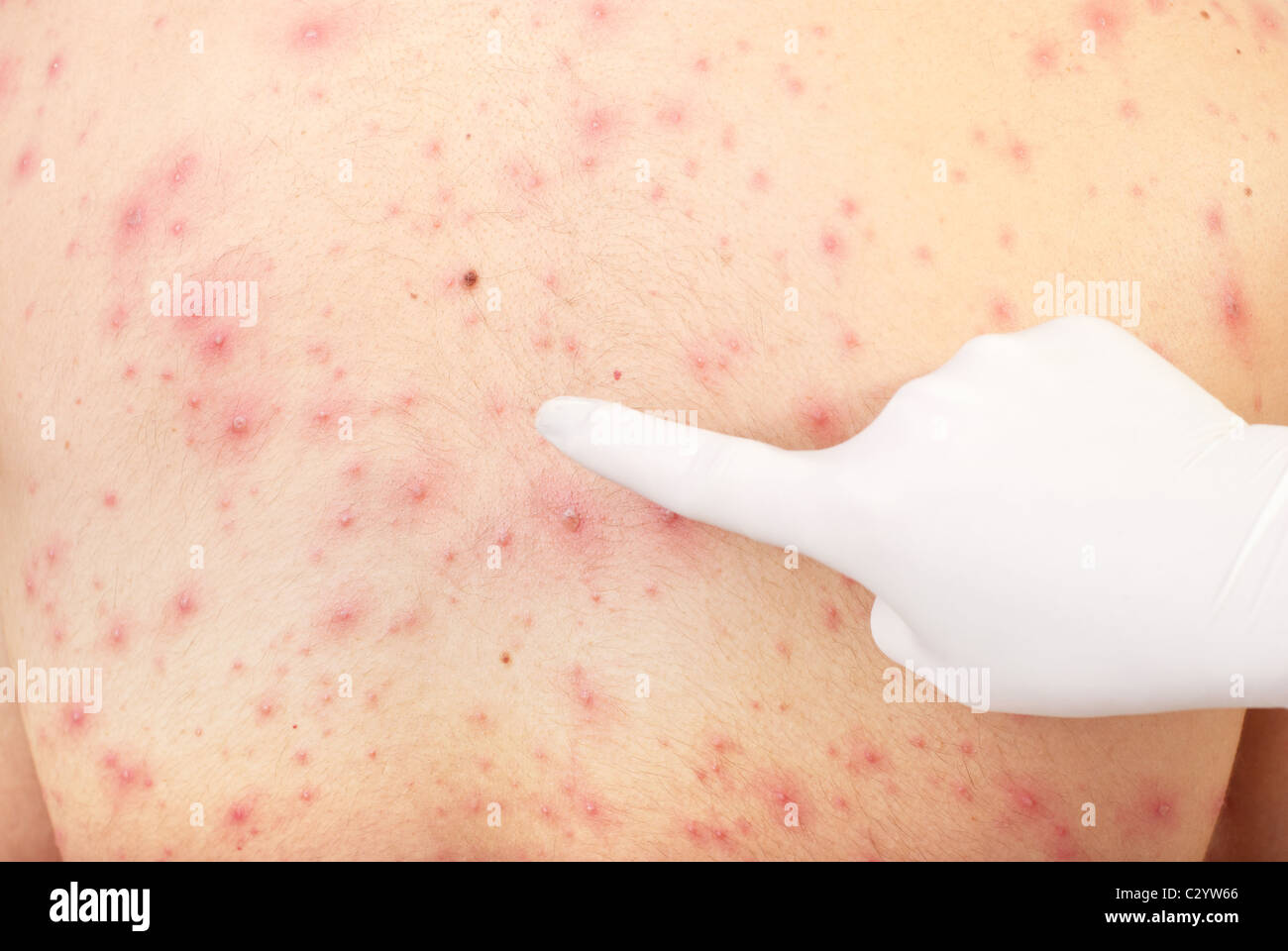 Erupciones En La Piel Fotos E Imagenes De Stock Alamy Erupciones En La Piel Fotos E Imagenes De Stock Alamy