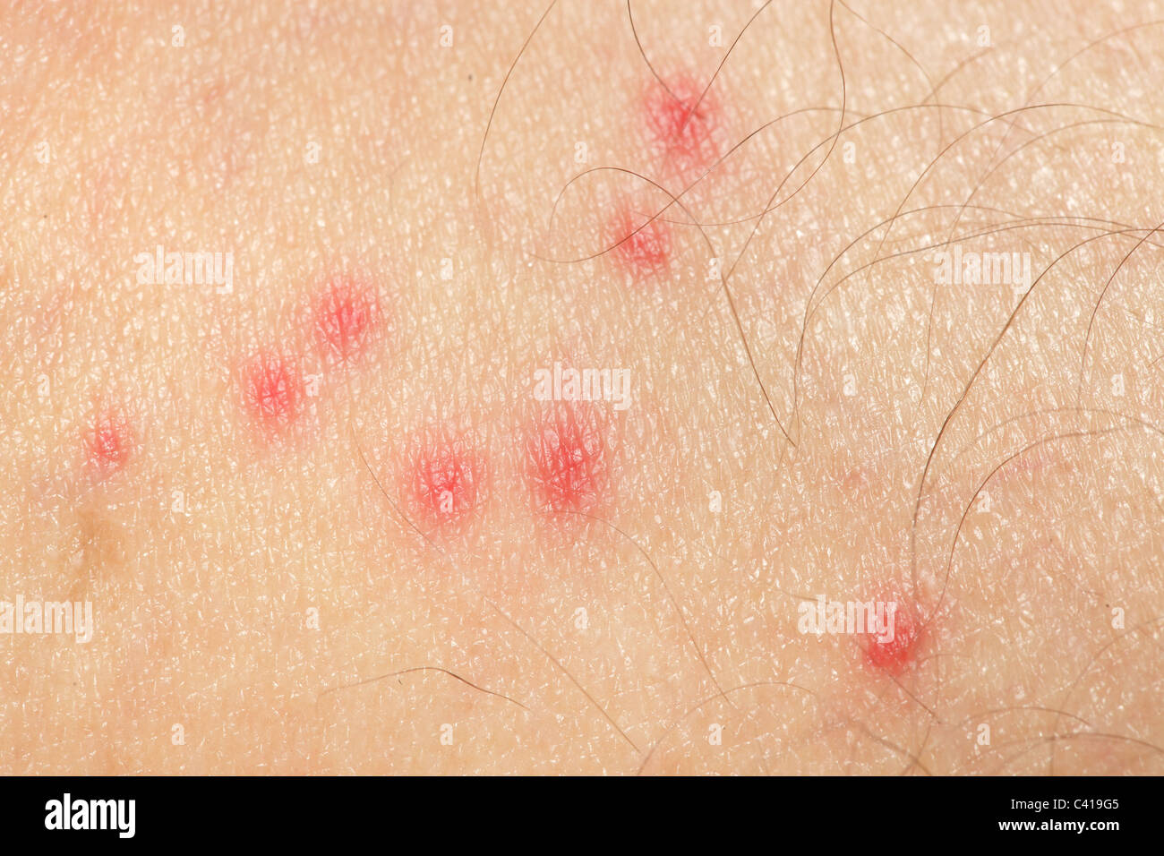 Macro de las picaduras de mosquitos alergia en la piel masculina Foto de stock
