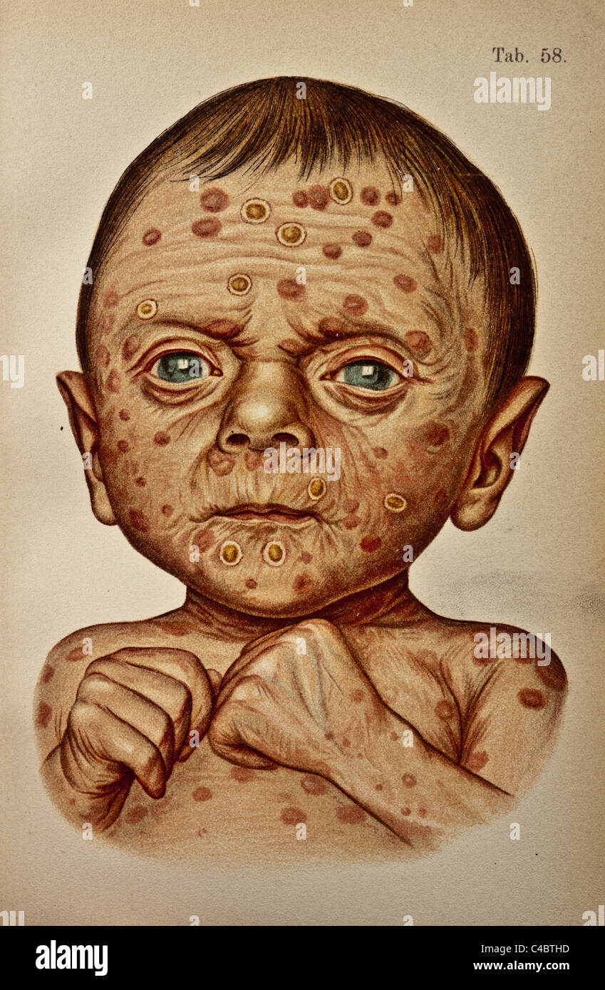 Ilustración de la Sífilis Congénita de un infante humano copyright 1898  Fotografía de stock - Alamy