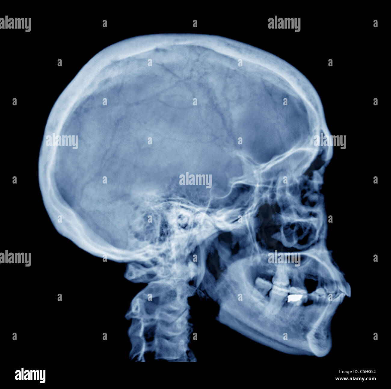 Cráneo normal, rayos X Fotografía de stock - Alamy