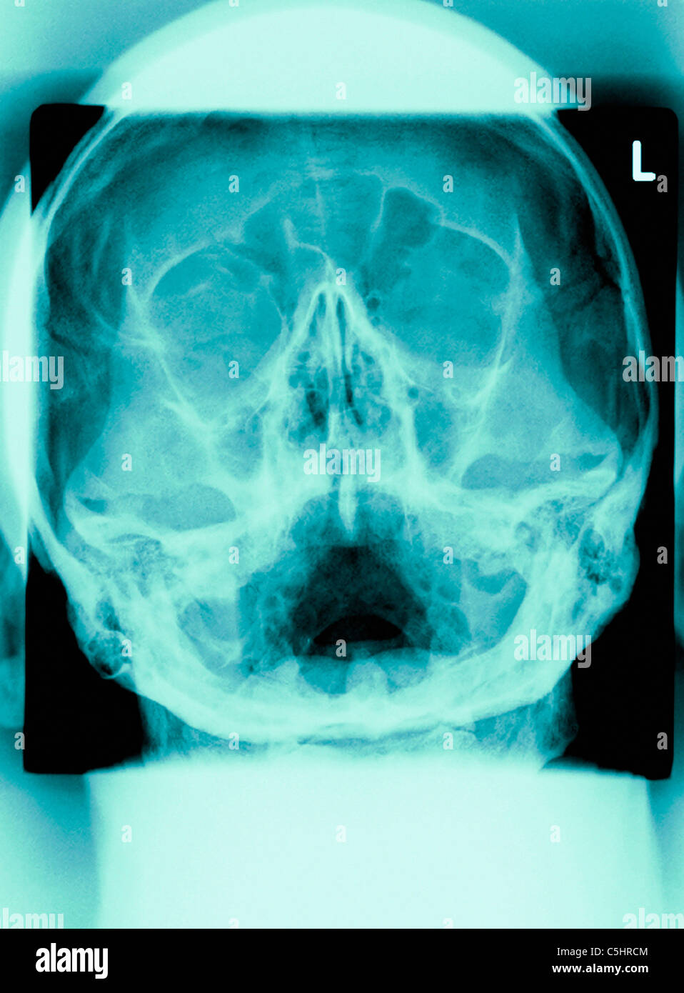 Radiografia frontal de craneo fotografías e imágenes de alta resolución Alamy Radiografia frontal de craneo fotografías e imágenes de alta resolución Alamy