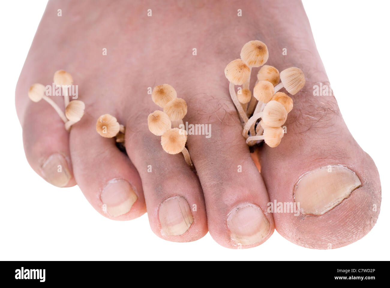 Sucio pie infectado micosis sobre fondo blanco. Foto de stock