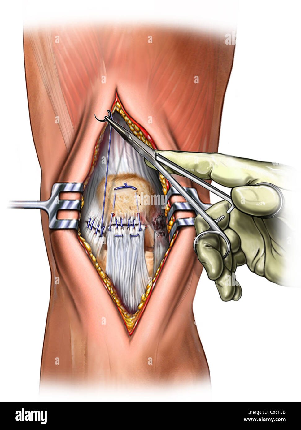 Esta ilustración médica ofrece una incisión abierta de la rodilla y muestra  la sutura reparación del desgarro retinaculum Fotografía de stock - Alamy