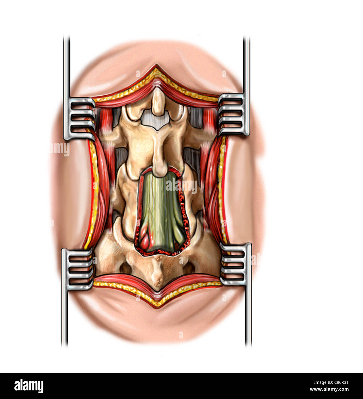 L4 S1 Una Laminectomía Y La Izquierda L5 S1 De Hernia Discal Fotografía De Stock Alamy