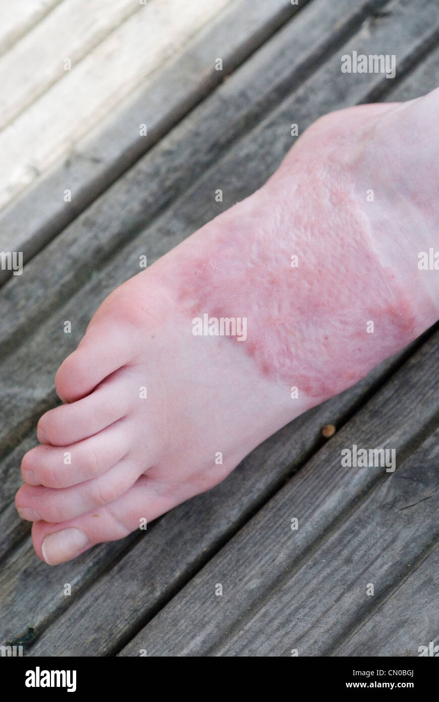 Lesiones por quemadura en el pie de la mujer joven. Foto de stock