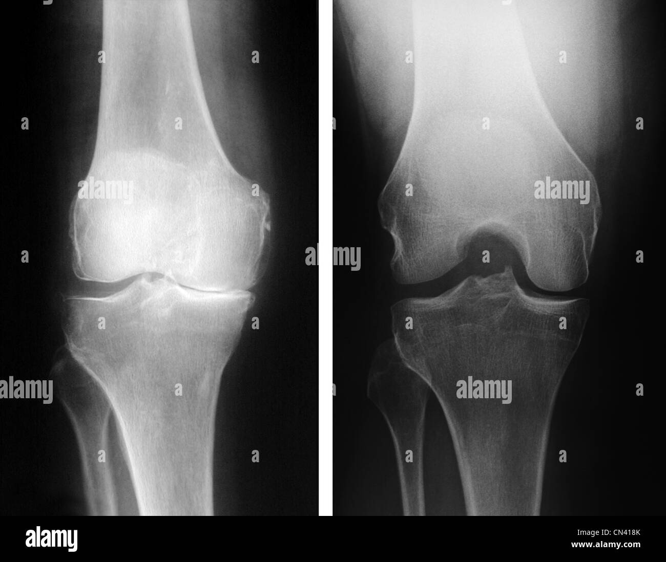 Normal knee x ray fotografías e imágenes de alta resolución - Alamy