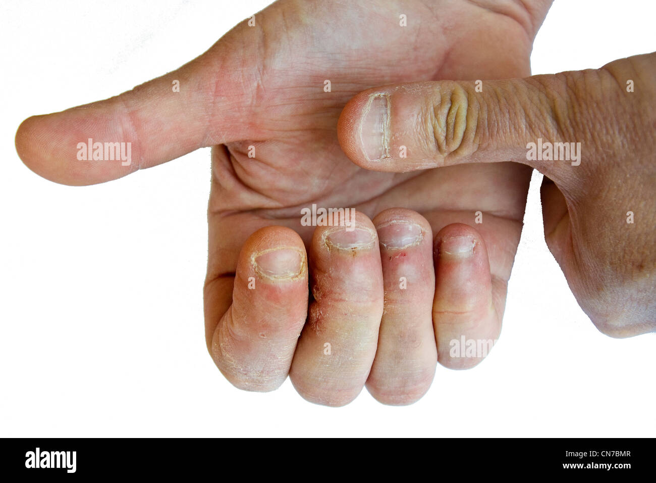 Uñas mordidas fotografías e imágenes de alta resolución - Alamy