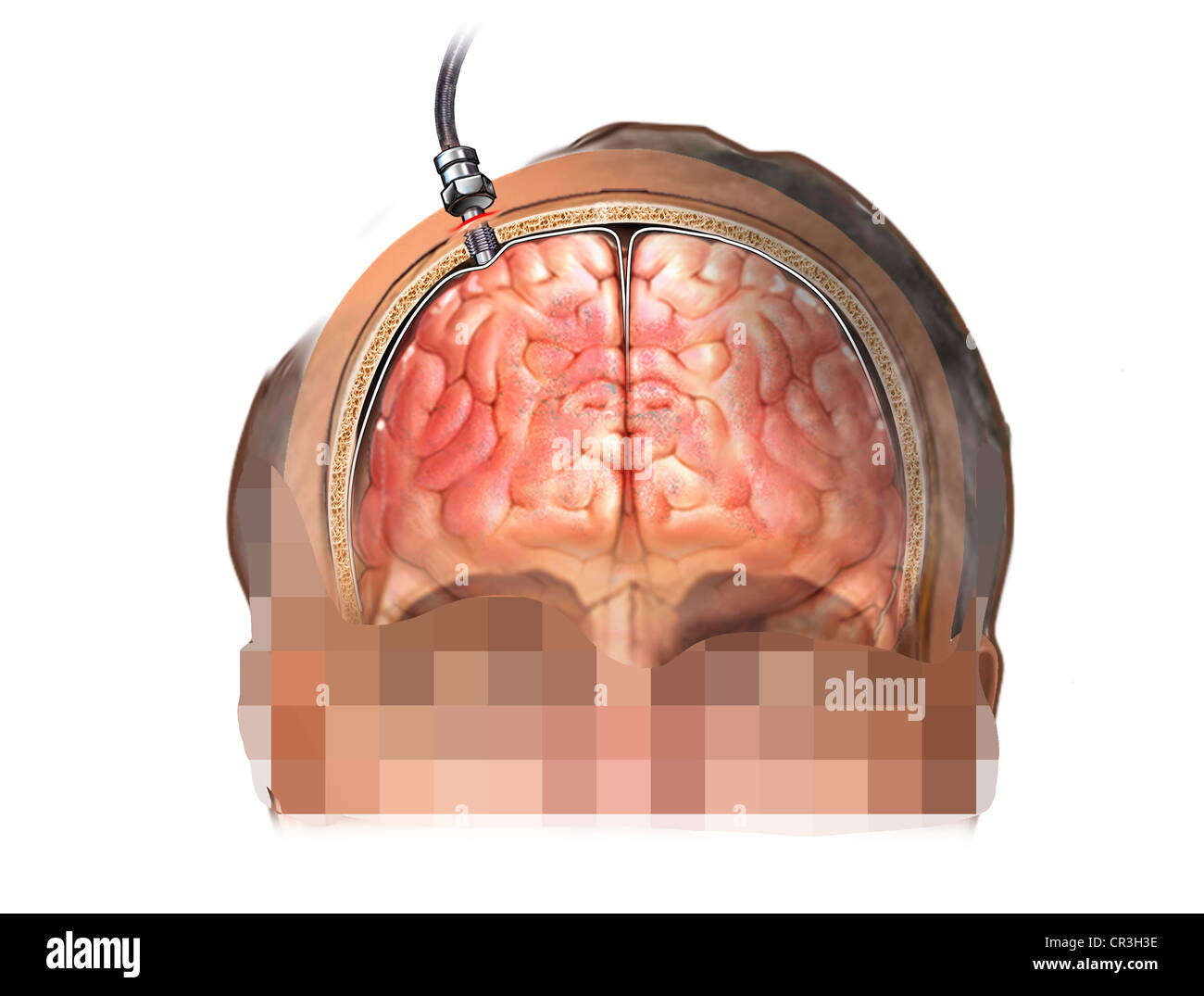 Presion intracraneal fotografías e imágenes de alta resolución Alamy