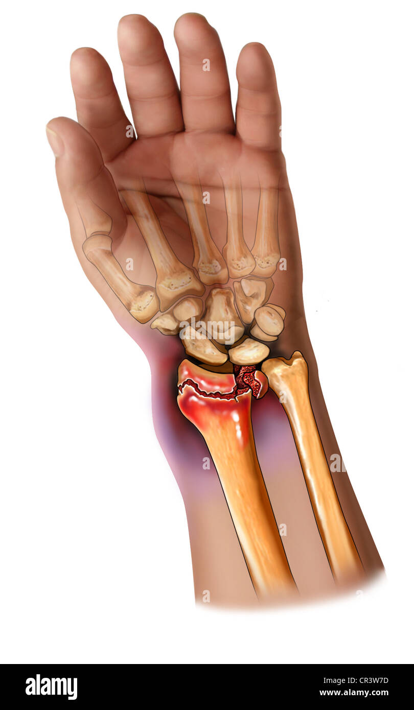 Fracturas distales del radio Fotografía de stock - Alamy