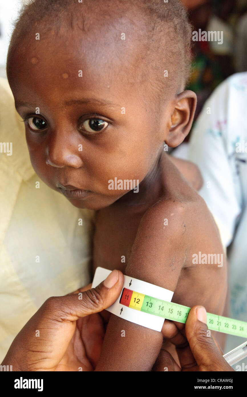 Garsiline Koko, 3, quien sufre de desnutrición, tiene sus brazos medido en el centro de salud de canalización en Monrovia Foto de stock