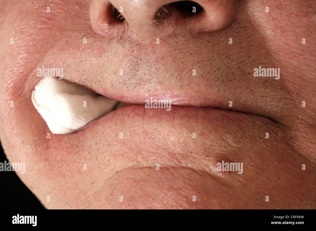 Un hombre morder abajo en una gasa de algodón para detener el sangrado de las encías después de un diente extraído. Foto de stock