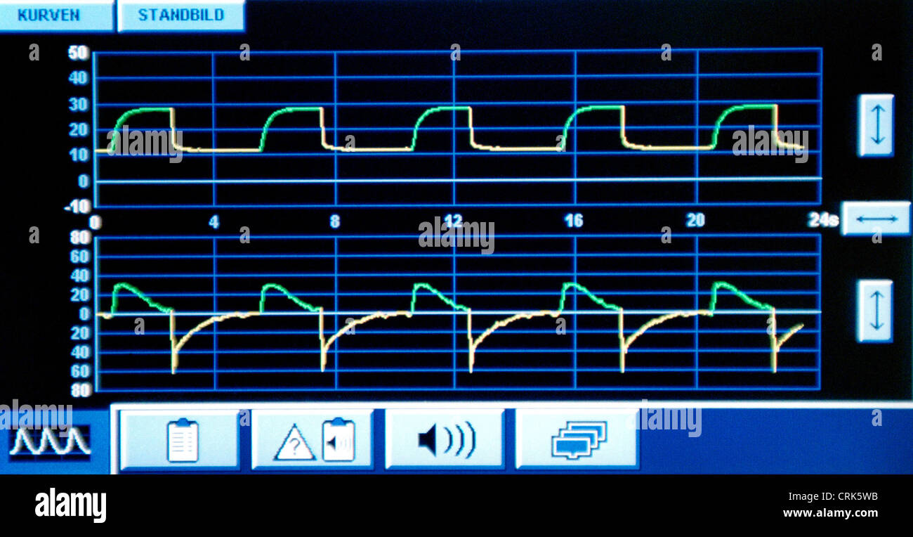 Monitor de visualización de la frecuencia cardíaca y respiratoria en un Beatmungsgeraet Foto de stock