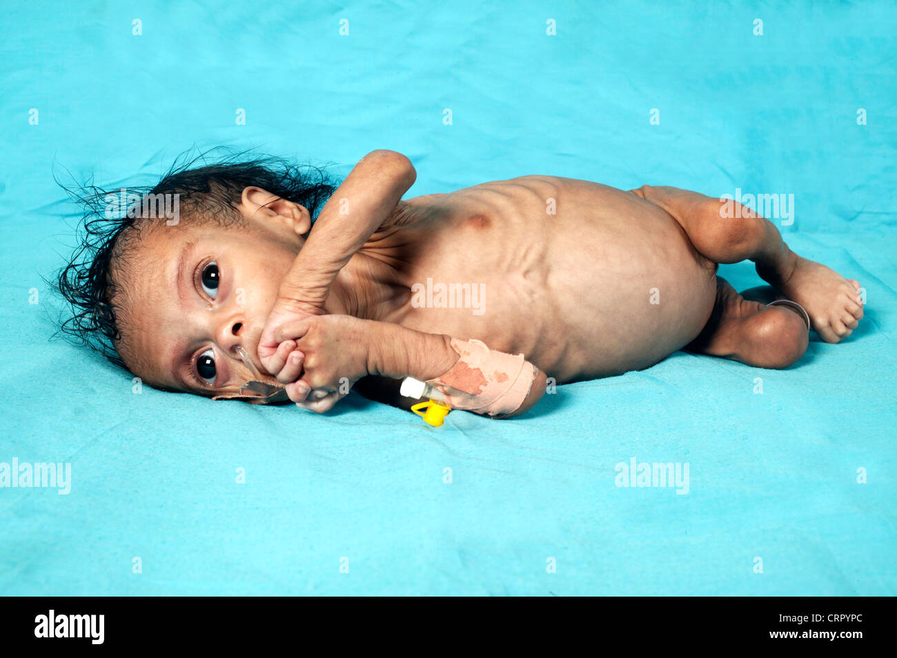 Niño que sufre distencion abdominal 3 meses - hepatoesplenomegalia y desnutrición Foto de stock