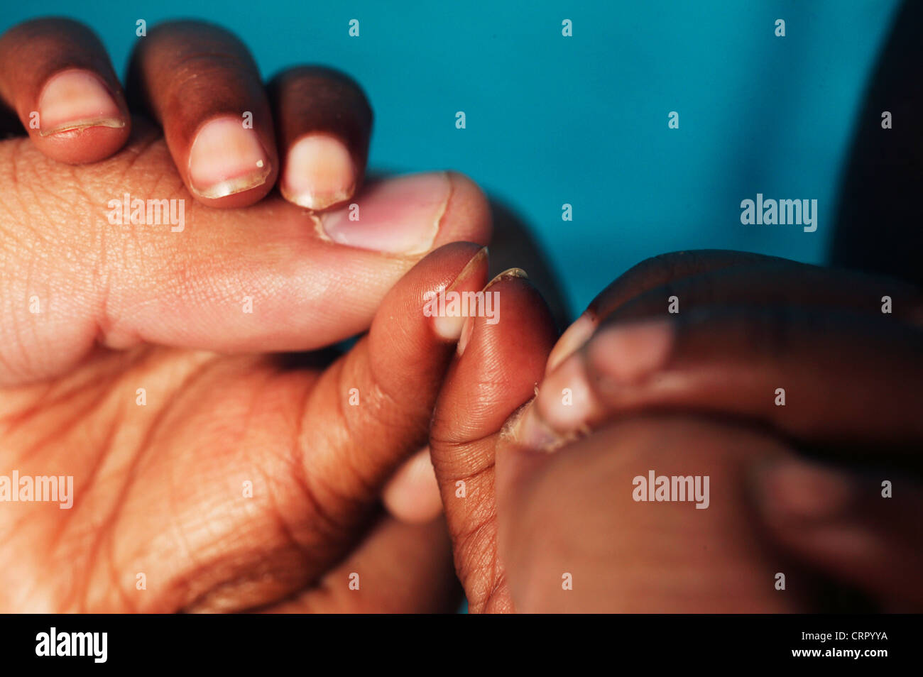 Adulto manos sostienen la mano de un niño padece malnutrición Edematus y deformación de los dedos de la mano Foto de stock