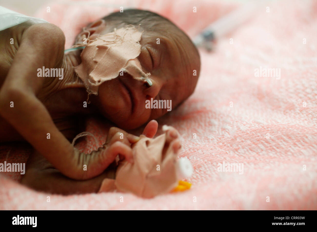 5 días de nacido el bebé prematuro a las 31 semanas pesa 1Kg, con síndrome de dificultad respiratoria y la ictericia. Foto de stock