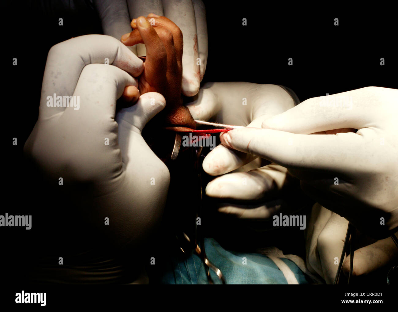 La mano del bebé con síndrome de TAR sometidos a cirugía. Foto de stock