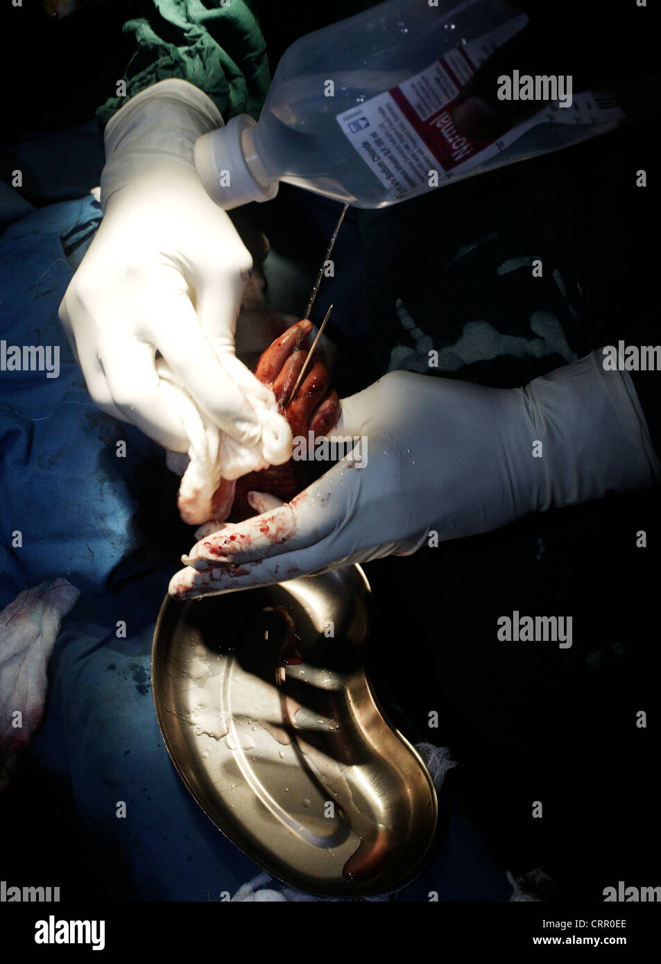 La mano del bebé con síndrome de TAR sometidos a cirugía. Foto de stock