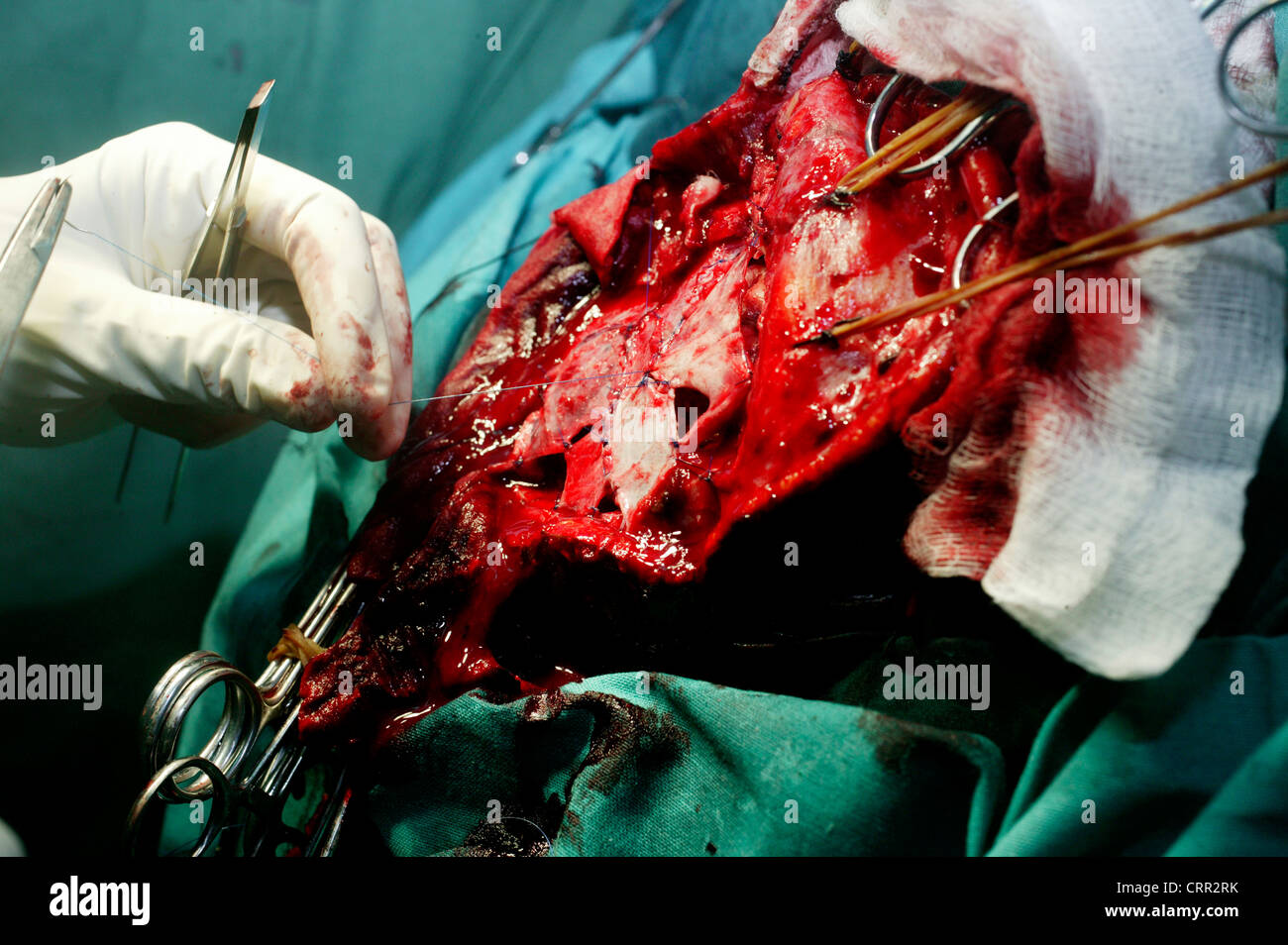 Un neurocirujano cosiendo fragmentos del techo del cráneo de nuevo juntos. Foto de stock
