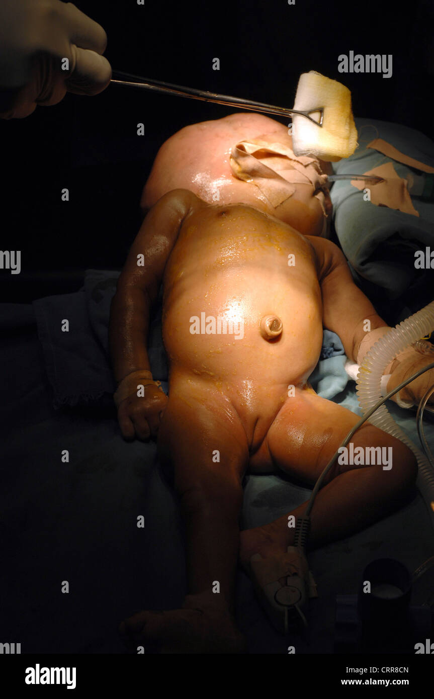 El cuerpo del niño se limpia con yodo povidona (PVPI) antes de la cirugía. Foto de stock