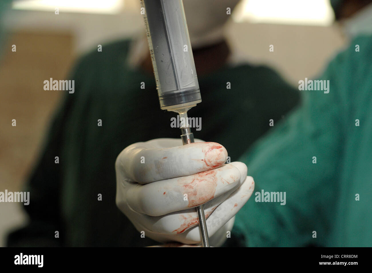 Los cirujanos extracto líquido de una jeringa. Foto de stock