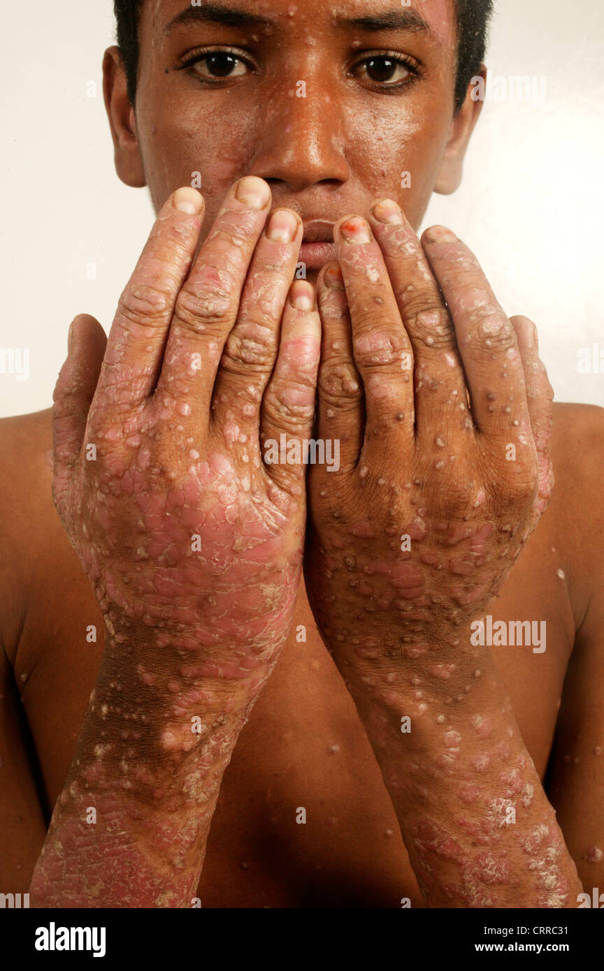 Un hombre joven con eritrodermia de las manos. Foto de stock