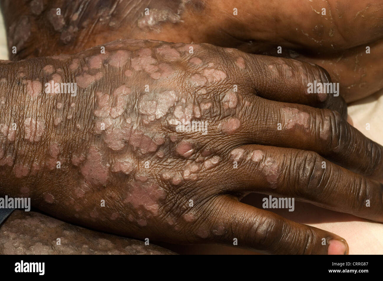 Un paciente con psoriasis severa, extensa a lo largo de todo su cuerpo. Foto de stock