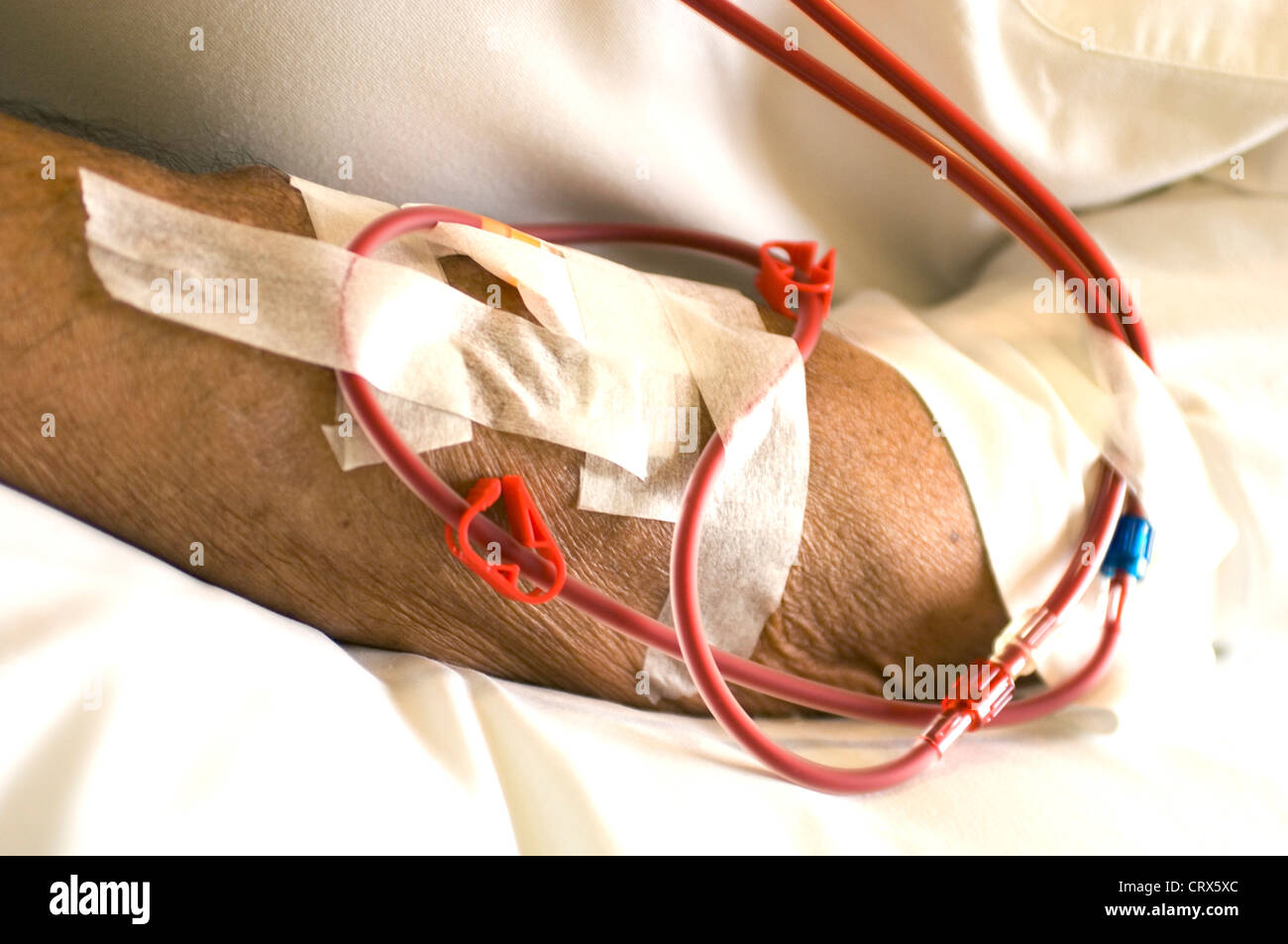Un brazo de pacientes en diálisis renal. Foto de stock